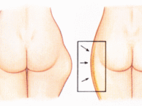 지방흡입의 기초지식