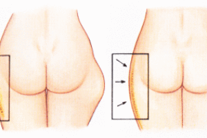 지방흡입의 기초지식